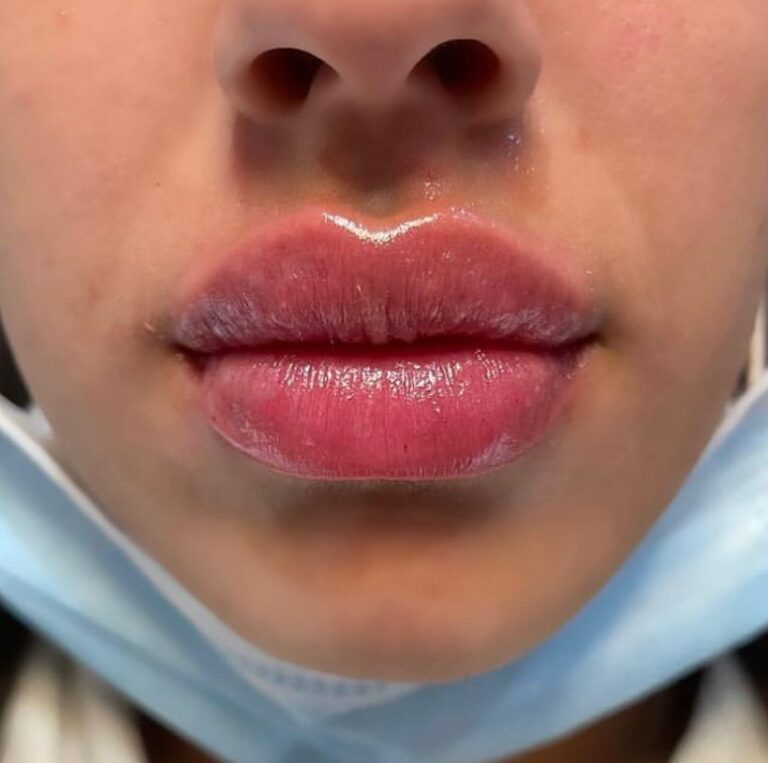 6-month-lip-injectables