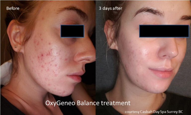 before-and-after-oxygeneo-3