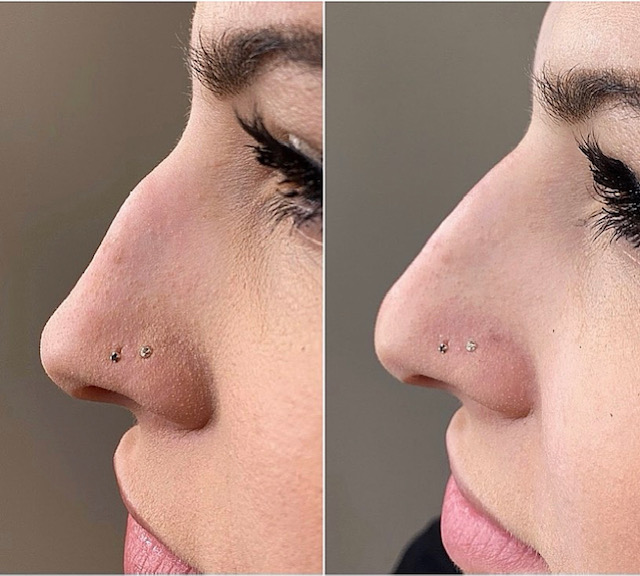 injectable-nose
